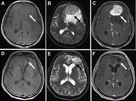 Frontal Lobe Tumor Surgery