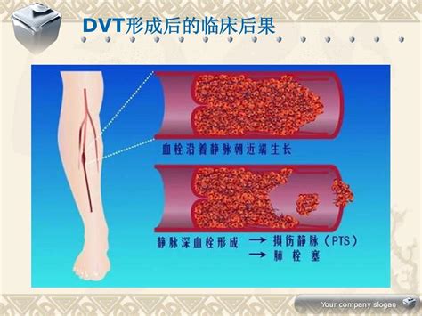 下肢深静脉血栓查房word文档在线阅读与下载免费文档