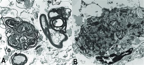 Ultrastructural examination of the lesion by electron microscopy. A ... 