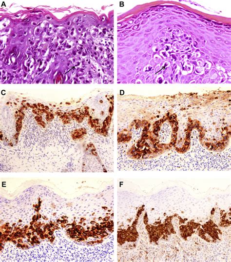 Extramammary Pagets Disease Of The Oral Mucosa And Perioral Skin