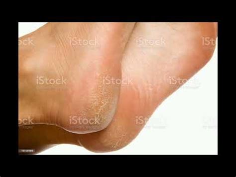 Crack Heels Home Remedy How To Treatment At Home Remove Cracked Heels