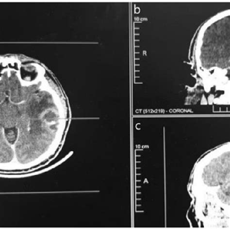 Patient Ct Scan Acquired On The Three Planes A Preoperative Axial Ct Download Scientific