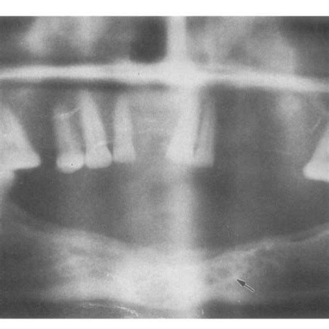 Panoramic Radiograph Shows Multilocular Radiolucency In Mandible Arrow