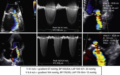 Basic Principles Of The Echocardiographic Evaluation Of Mitral