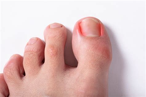 Ingrown Toenail Management West Lakes Podiatry