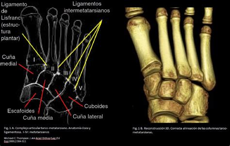 Figure From Fractura Luxaci N De Lisfranc Aportaci N Del Tcmd