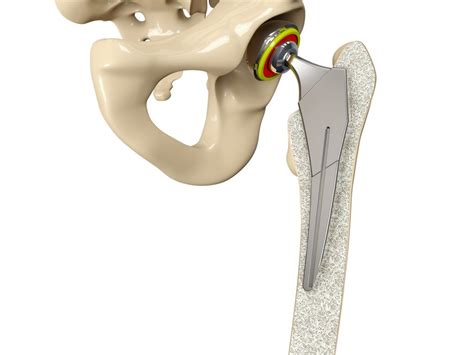 Ayurvedic Treatment For Avascular Necrosis