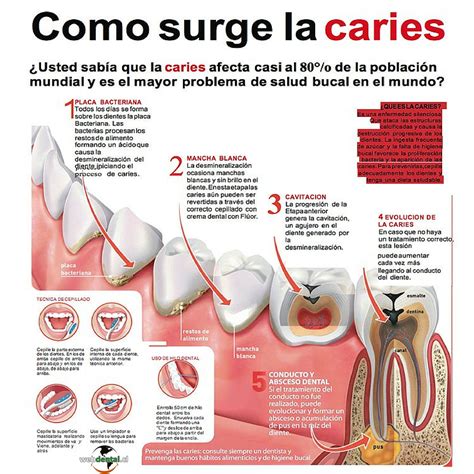 Origen De Las Caries Webdental Cl Noticias De Odontologia