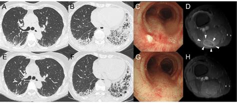 Radiological And Bronchoscopic Findings Chest CT On Admission Showed