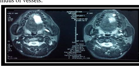 Figure 3 From Arterio Venous Malformation Of Tongue A Case Report