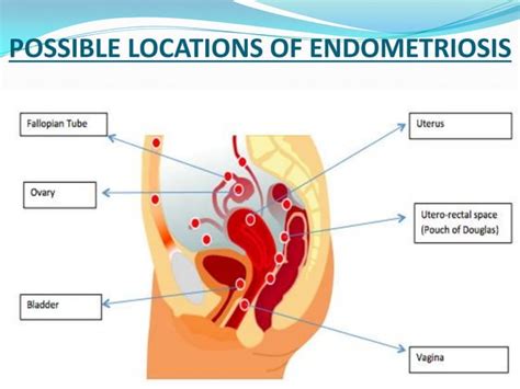 Endometriosis Easy Explanation With Management Ppt