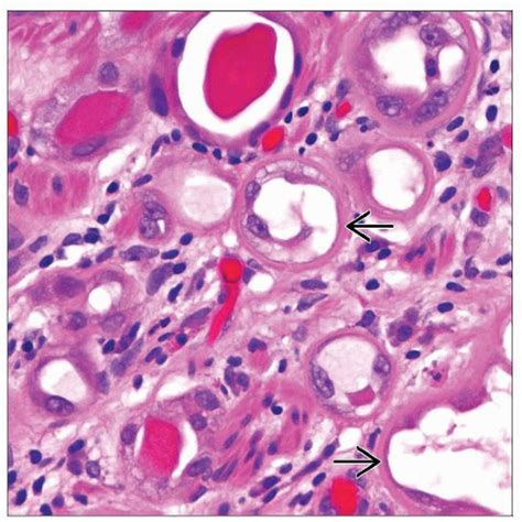 Nephrogenic Adenoma Of The Prostatic Urethra Basicmedical Key