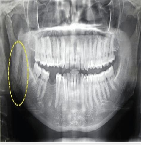 Orthopantomogram Of The Patient Yellow Circle Shows The Area Of