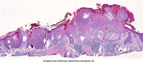 Seborrheic Keratosis Histology