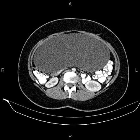 Ovarian Serous Cystadenoma Image