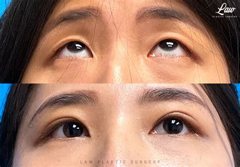 Asian Eyelid Surgery Before After Photos Sage Plastic Surgery