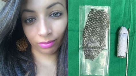 Brasileña nació sin vagina y le hicieron una