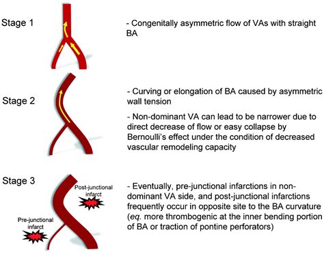 vertebral artery stenosis symptoms - Captions Graphic