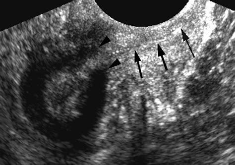 Rectovaginal Fistula Ultrasound