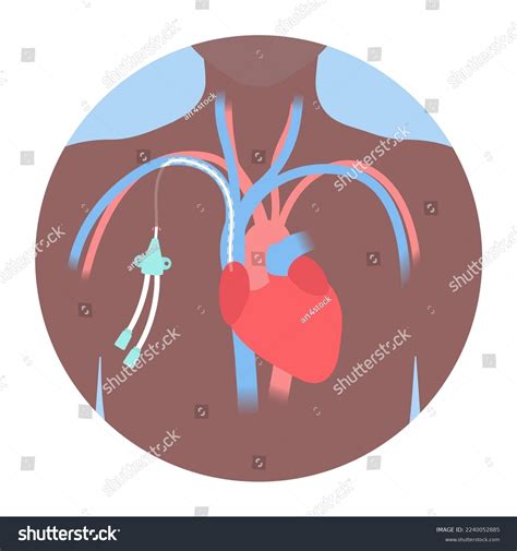 Tunneled Central Venous Catheter Placed Subclavian เวกเตอร์สต็อก ปลอดค่าลิขสิทธิ์ 2240052885