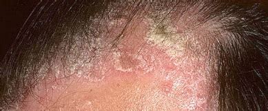 Scalp Psoriasis Treatment | Favoriteplus.com Blog