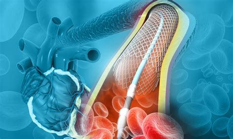 Cateterismo E Angioplastia - Cateterismo e angioplastia na coronária: entenda o que são e como são ...