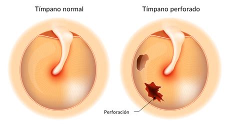 Tímpano perforado Signos síntomas y tratamiento