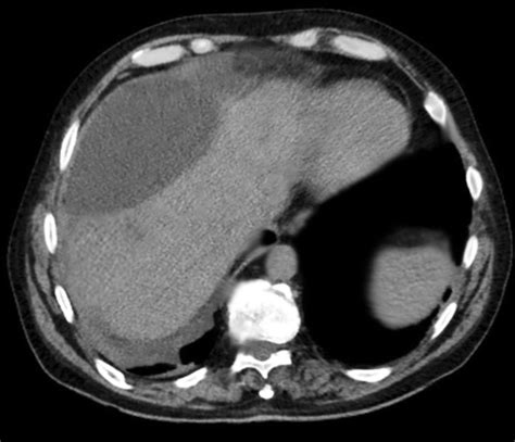 Figure CT Image Showing Hepatic Biloma Contributed By Rian Kabir MD