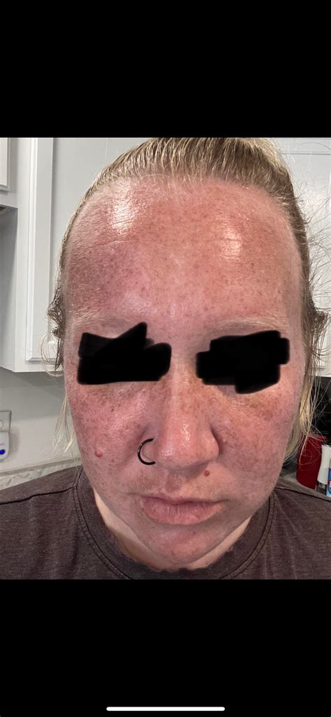 Do you see progress? : r/Skincare_Addiction