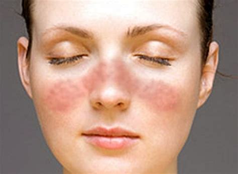 👉 Lupus Rash - Pictures, Symptoms, Causes, Treatment (December 2021)