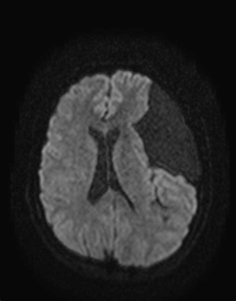 Compressive Arachnoid Cyst Middle Cranial Fossa Image