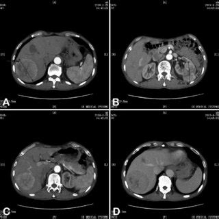 ct imaging  fnh  tae  ple ct images showed   volume