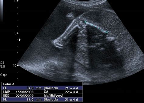 Acardiac Twin Trap Sequence Image To U