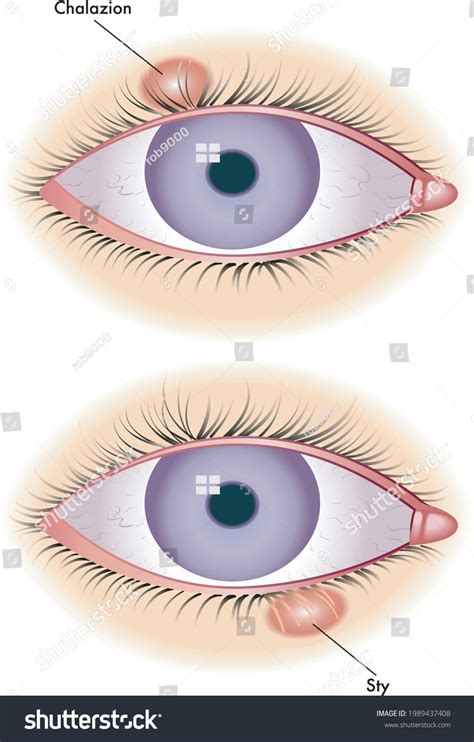 Meibomian Cyst Over 3 Royalty Free Licensable Stock Illustrations And Drawings Shutterstock