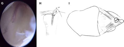 Arthroscopically Assisted Reconstruction Of Triangular Fibrocartilage