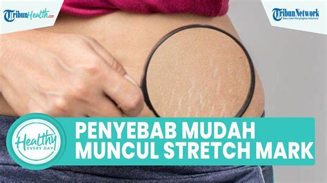 Inilah Penyebab Kulit Mudah Muncul Stretch Mark Faktor Genetik Hingga