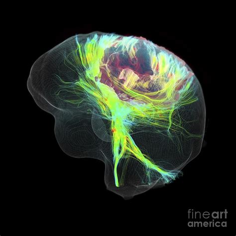 Glioblastoma Brain Tumour, Dti Mri Scan Photograph by Sherbrooke ...