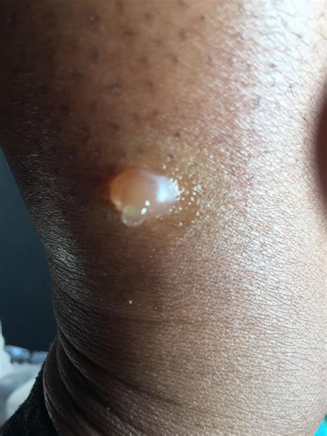 Extremely painful blister from a mosquito bite : r/popping