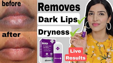 Derma Co Kojic Acid Lip Balm Review Reduces Lips Pigmentation Dryness