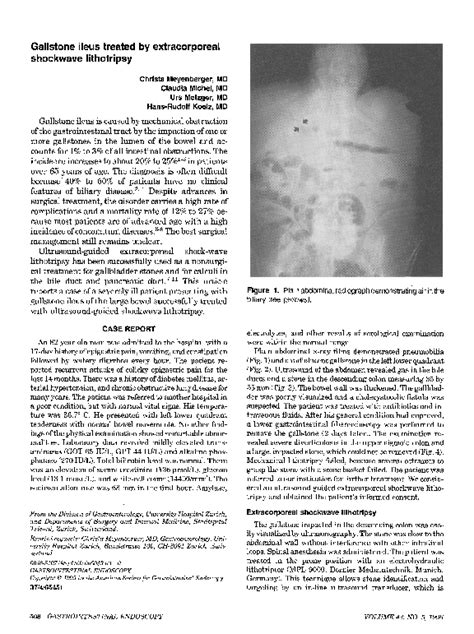 Pdf Gallstone Ileus Treated By Extracorporeal Shockwave Lithotripsy