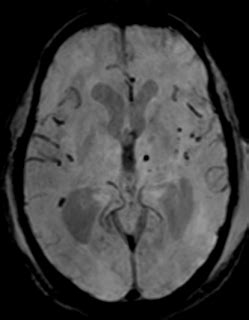 Amyloid Angiopathy: MRI - Sumer's Radiology Blog