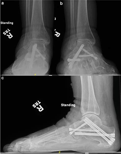 Six Month Status Post Right Ankle Triple Arthrodesis Standing