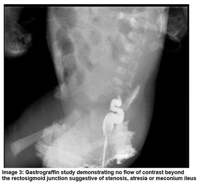 Meconium Ileus in Two Irish Newborns: The Presenting Feature of Cystic ...