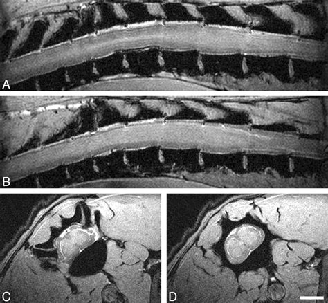 In Vivo High Resolution Mr Imaging Of Neuropathologic Changes In The