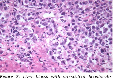 Figure From Plasmablastic Myeloma Presenting With Nodular Liver