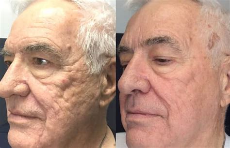 Erbium Fractional Laser Resurfacing