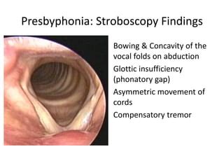 Presbyphonia aging & voice | PPT