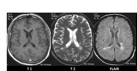 IRM cérébrales et médullaires pathologiques dans le cas d une SCLEROSE