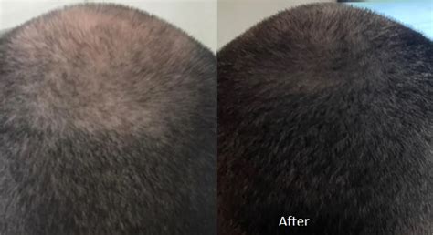 10 Weeks On Finasteride And Minoxidil Photo Wrassman M D Baldingblog