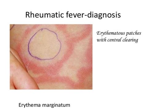 Rheumatic Fever